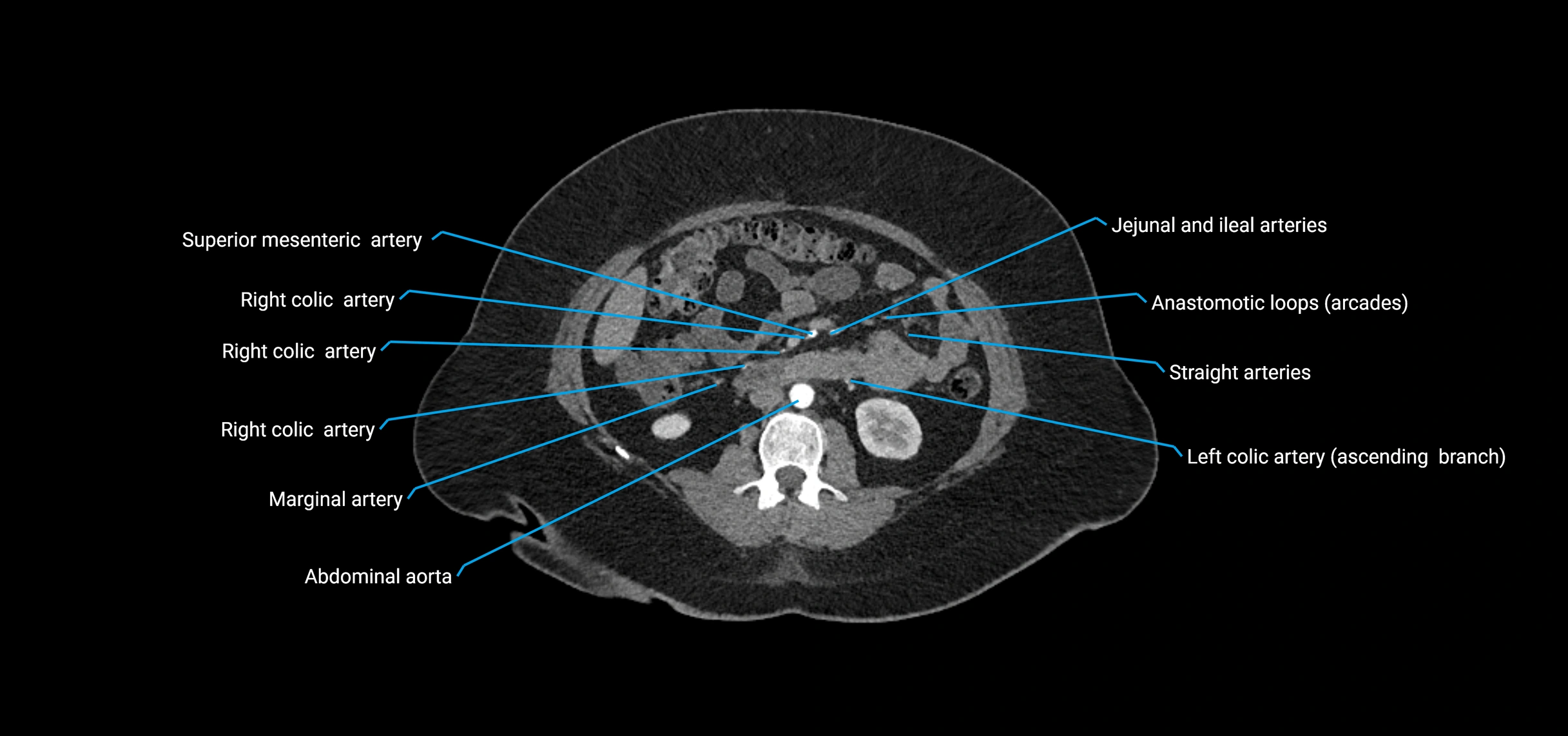 CTA abdomen axial cross sectional anatomy labelled image_94 (2).webp